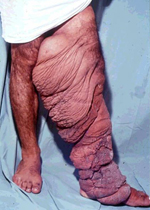 下肢リンパ浮腫の写真